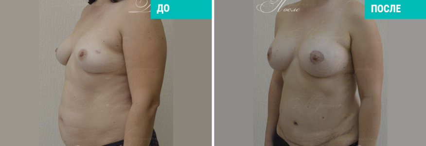 Увеличение груди + абдоминопластика + липосакция живота