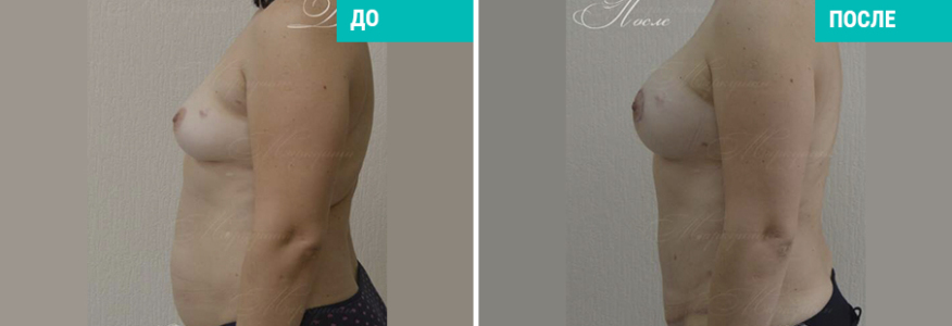 Увеличение груди + абдоминопластика + липосакция живота
