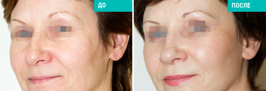 Одномоментная подтяжка лица и шеи и круговая блефаропластика 