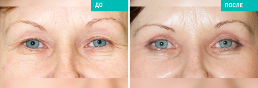 Одномоментная подтяжка лица и шеи и круговая блефаропластика 