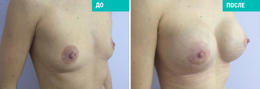 Увеличение груди