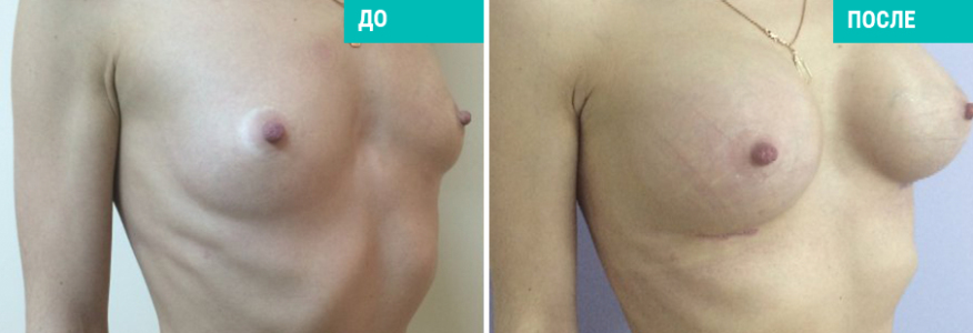 Увеличение груди
