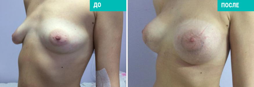 Увеличение груди