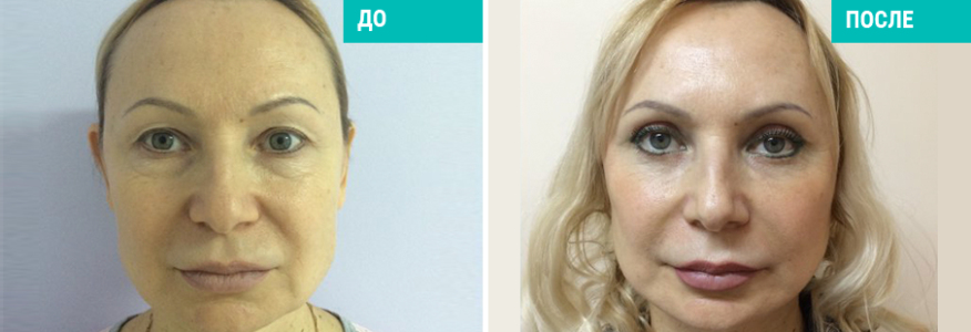 Комбинированное омоложение лица