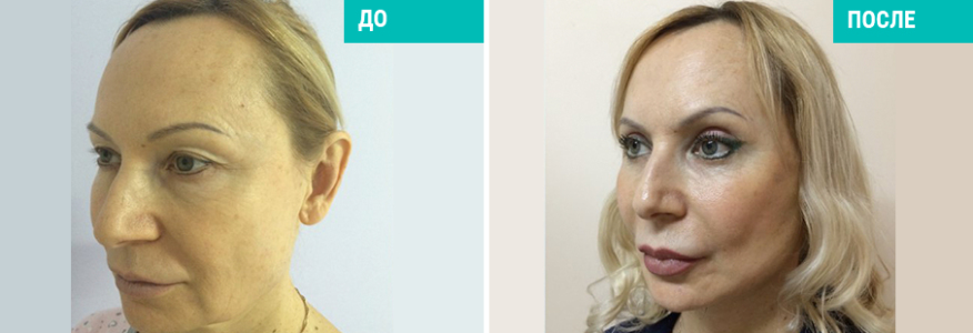 Комбинированное омоложение лица