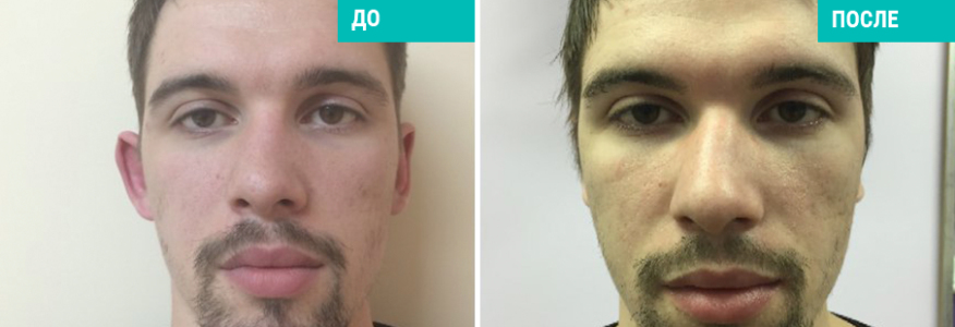 Отопластика