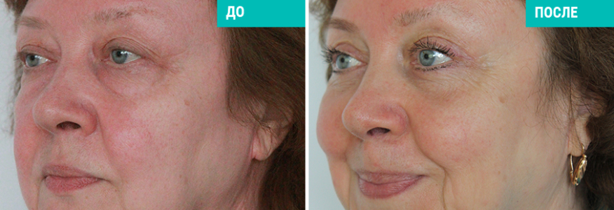 Блефаропластика