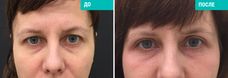 Блефаропластика