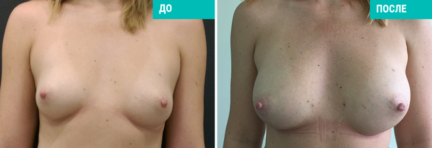 Липофилинг груди