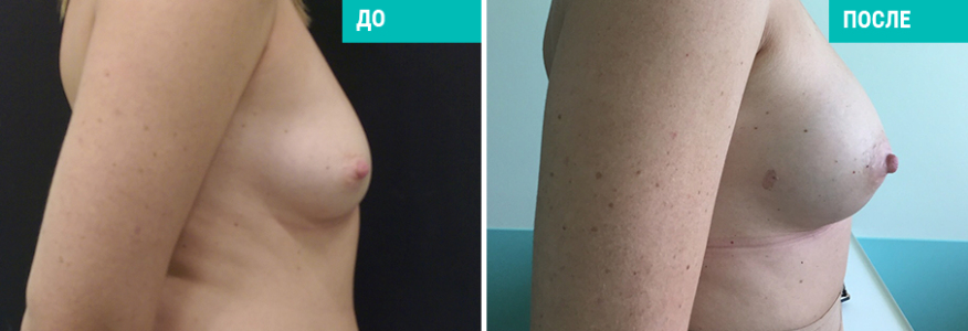 Липофилинг груди