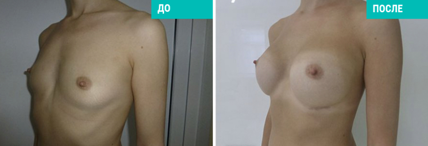 Увеличение груди