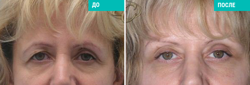 Блефаропластика