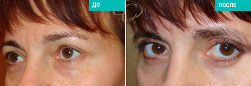 Блефаропластика