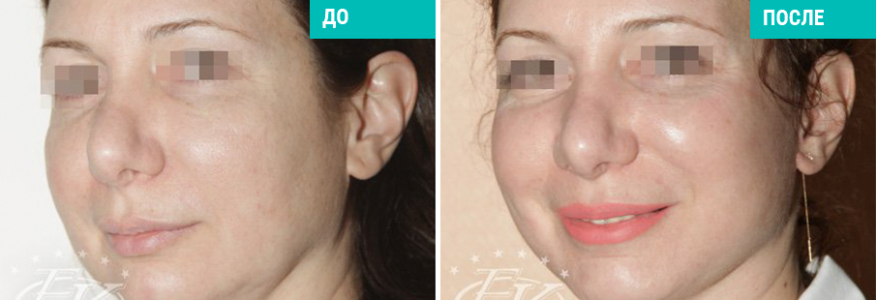 Подтяжка лица SMAS