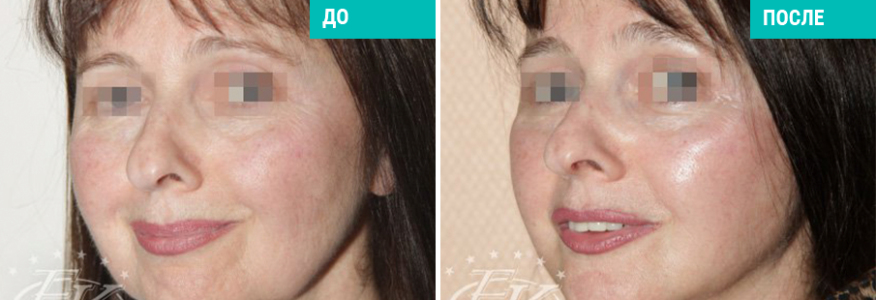 Подтяжка лица SMAS