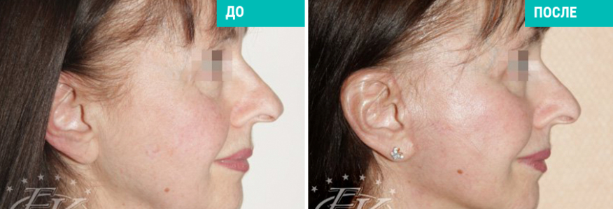 Подтяжка лица SMAS