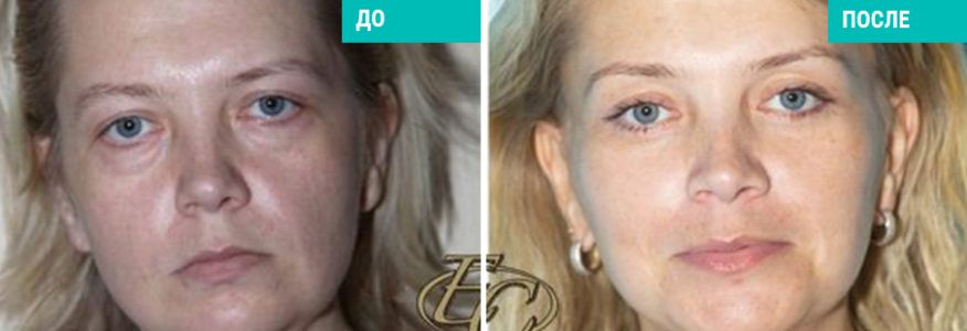 Подтяжка лица