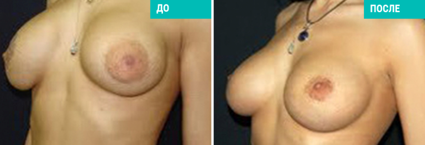 Подтяжка груди