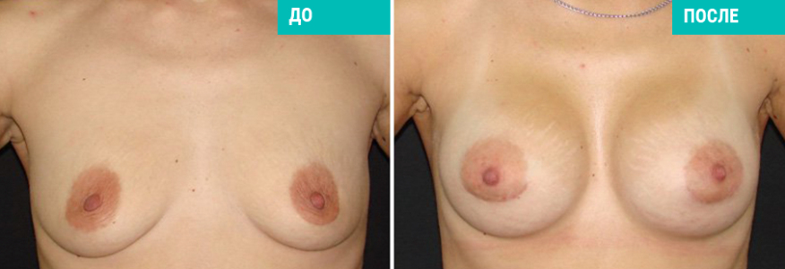 Увеличение груди