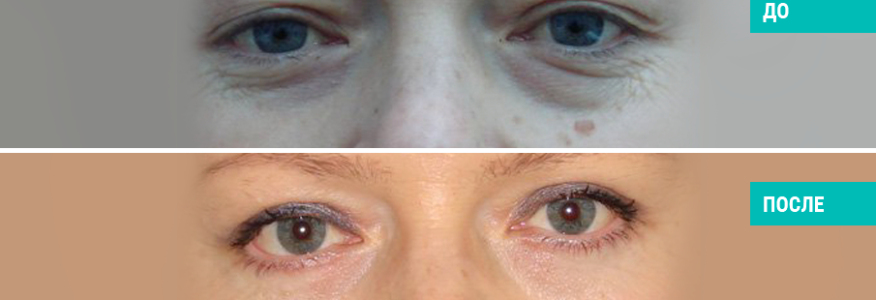 Блефаропластика