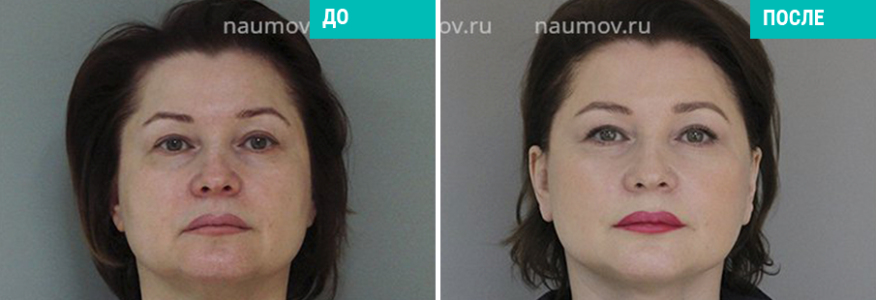 Спейслифтинг