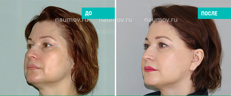 Версия вов 3. Липосакция до и после фото мужчины. Гагарина светлана вячеславовна абдоминопластика. Торсопластика до и после. 3.