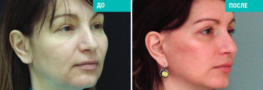 Спейслифтинг