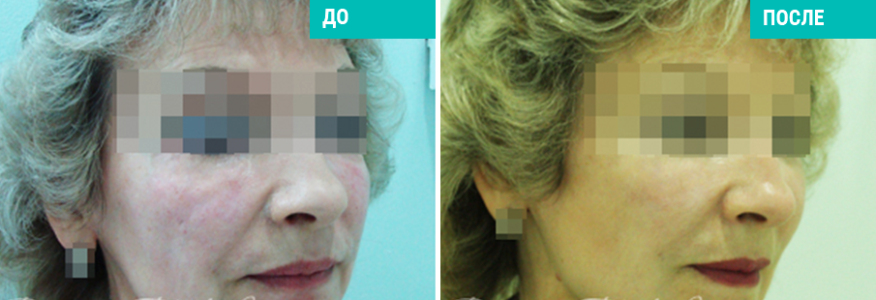 Софтлифтинг - безоперационная подтяжка лица