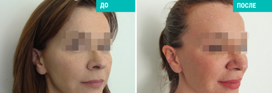 Софтлифтинг - безоперационная подтяжка лица