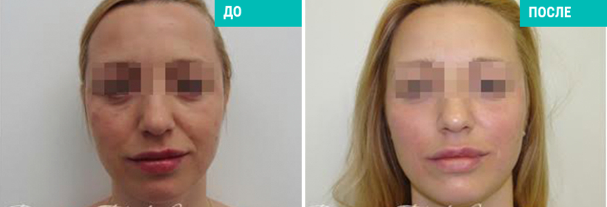 Софтлифтинг