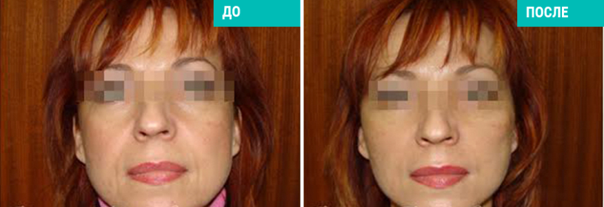 Подтяжка нитями Силуэт-Лифт 