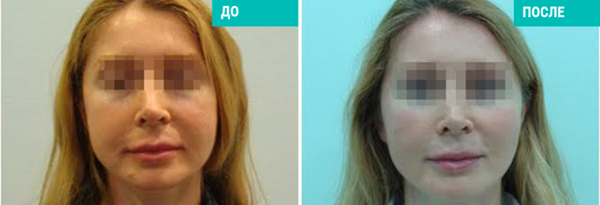 Подтяжка нитями Силуэт-Лифт 