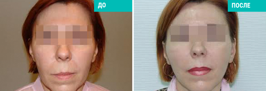 Подтяжка нитями Силуэт-Лифт 