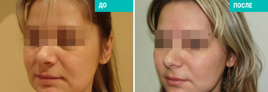 Подтяжка нитями Силуэт-Лифт 