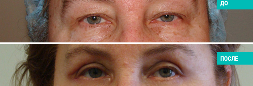 Блефаропластика