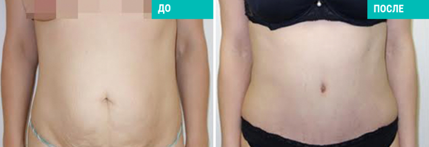 Абдоминопластика