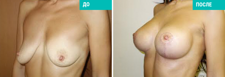 Подтяжка груди