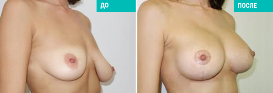 Подтяжка груди