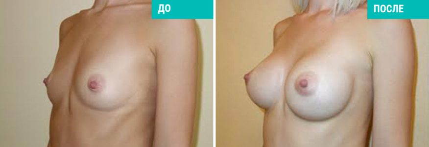 Увеличение груди