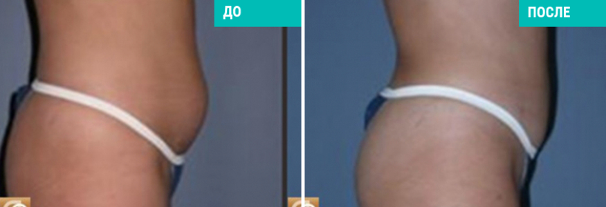 Липосакция