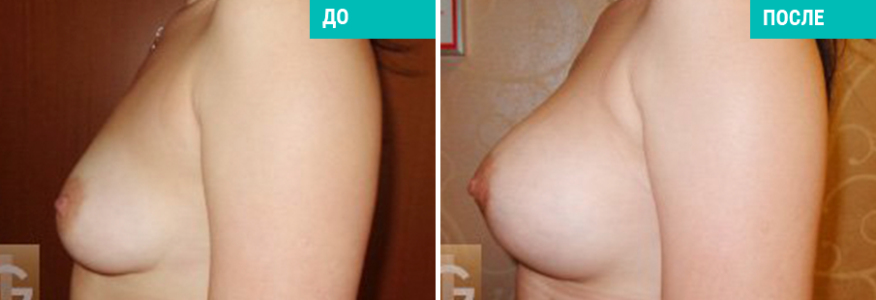 Увеличение груди