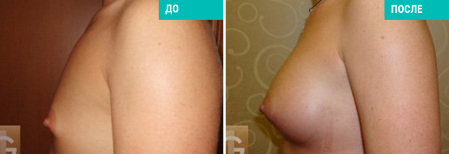 Увеличение груди