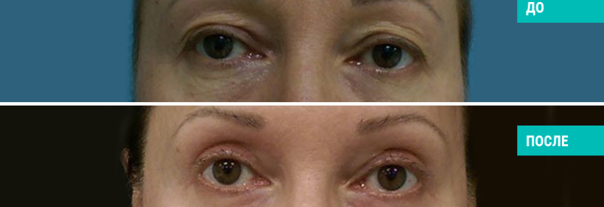 Блефаропластика