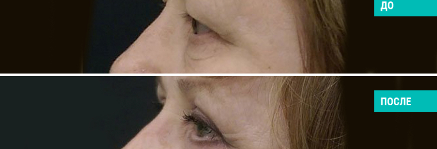 Блефаропластика