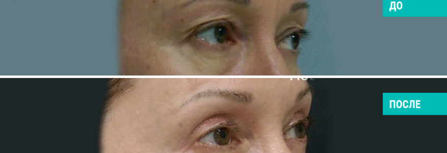 Блефаропластика