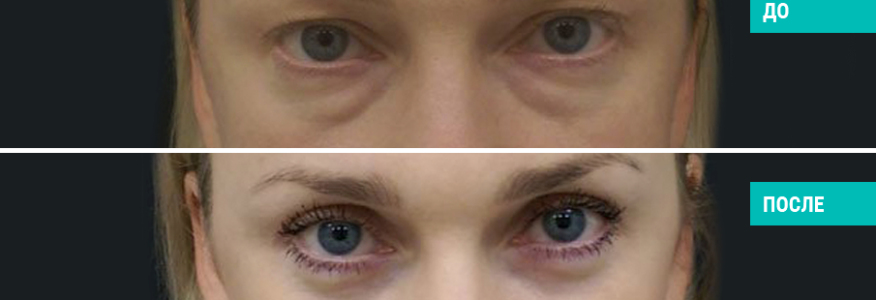 Блефаропластика