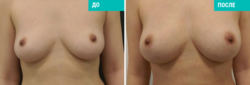 Липофилинг груди