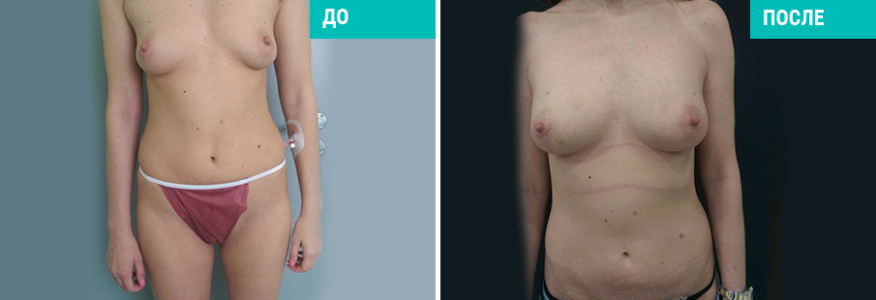 Липофилинг груди