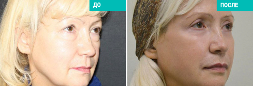 Васер моделирование лица