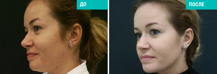 Васер моделирование лица